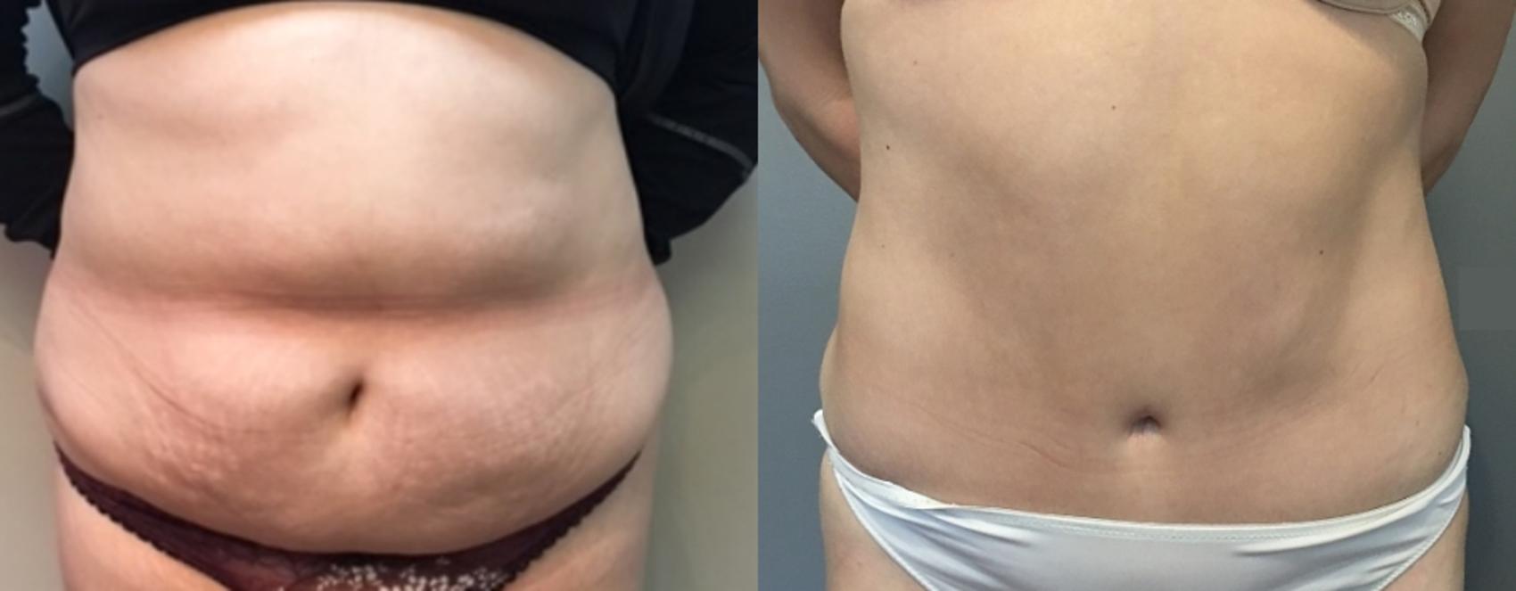 Before & After Tummy Tuck Case 107 Front View in Mississauga & Toronto, ON