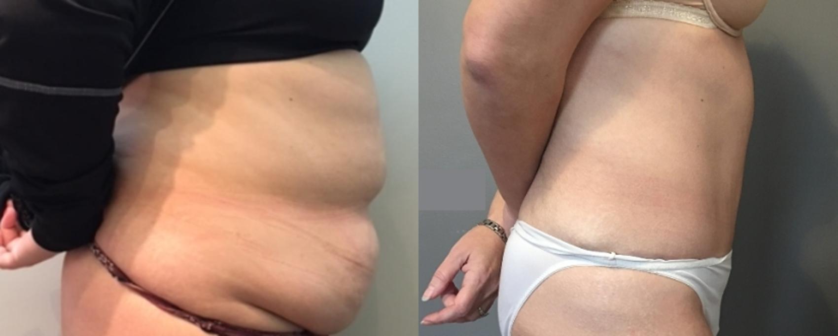 Before & After Tummy Tuck Case 107 Right Side View in Mississauga & Toronto, ON