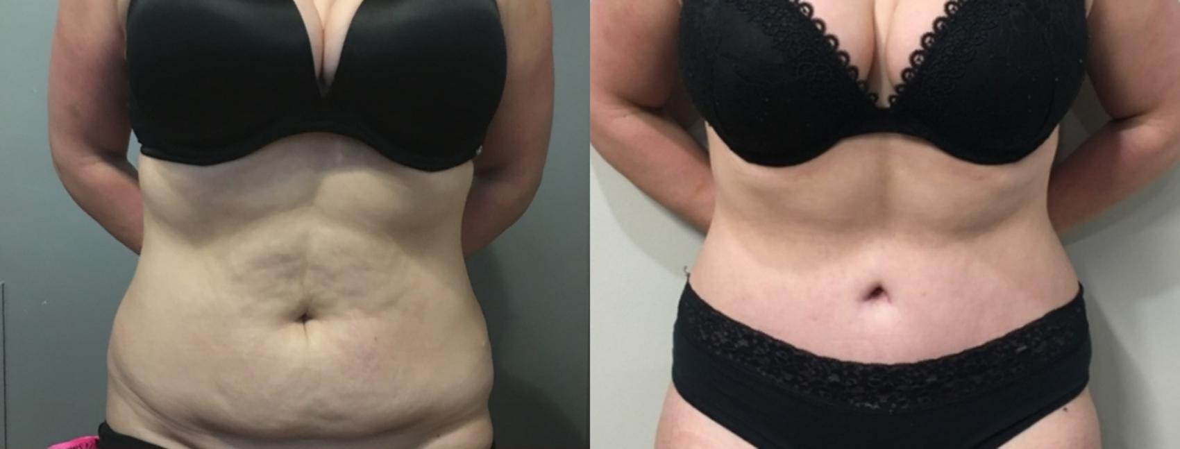 Before & After Tummy Tuck Case 109 Front View in Mississauga & Toronto, ON