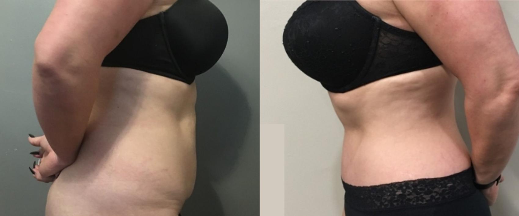 Before & After Tummy Tuck Case 109 Right Side View in Mississauga & Toronto, ON