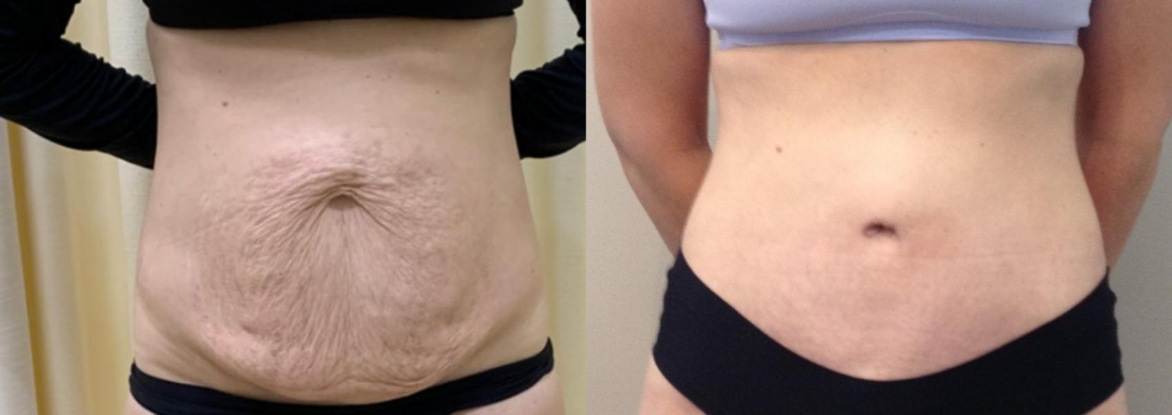 Before & After Tummy Tuck Case 111 Front View in Mississauga & Toronto, ON