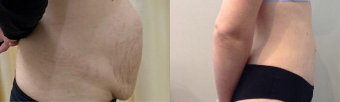 Before & After Tummy Tuck Case 111 Right Side View in Mississauga & Toronto, ON