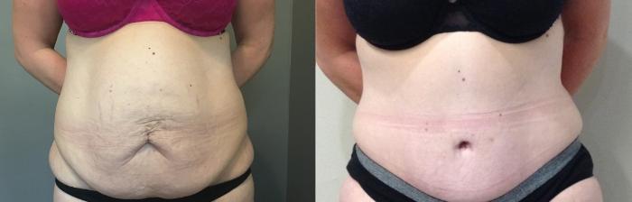 Before & After Tummy Tuck Case 112 Front View in Mississauga & Toronto, ON