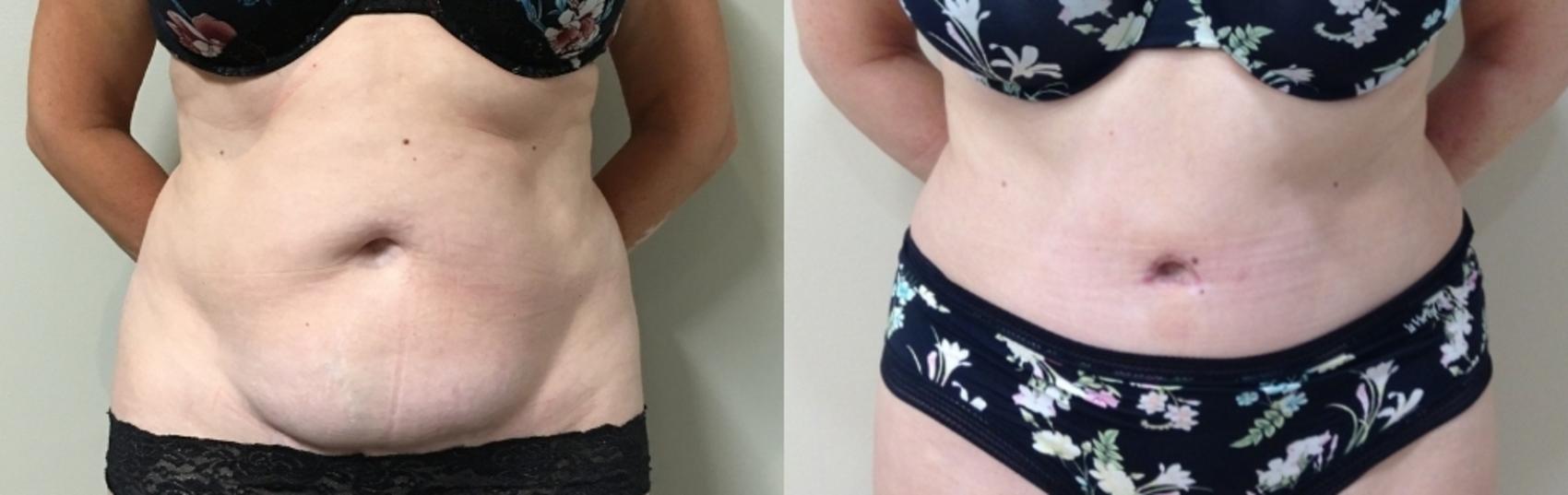 Before & After Tummy Tuck Case 115 Front View in Mississauga & Toronto, ON
