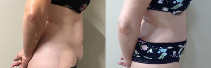 Before & After Tummy Tuck Case 115 Right Side View in Mississauga & Toronto, ON