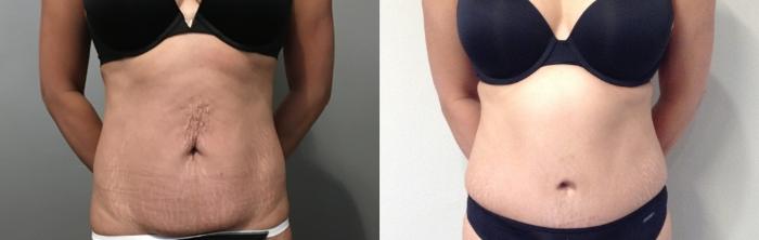 Before & After Tummy Tuck Case 116 Front View in Mississauga & Toronto, ON