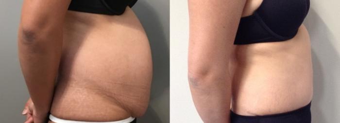 Before & After Tummy Tuck Case 116 Right Side View in Mississauga & Toronto, ON
