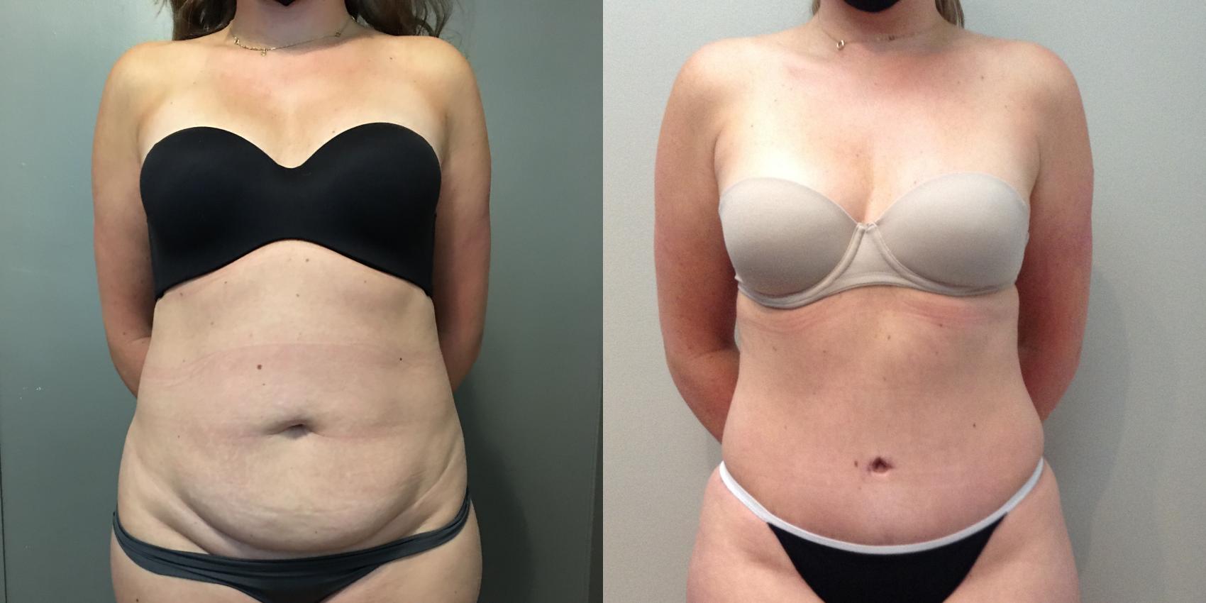 Before & After Tummy Tuck Case 117 Front View in Mississauga & Toronto, ON