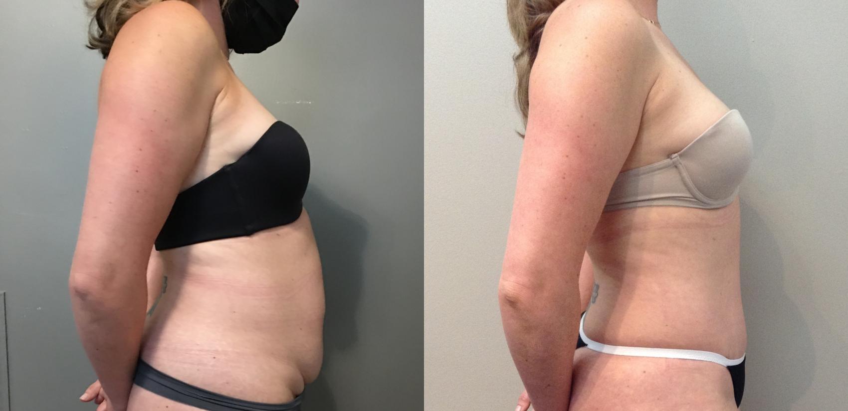 Before & After Tummy Tuck Case 117 Right Side View in Mississauga & Toronto, ON