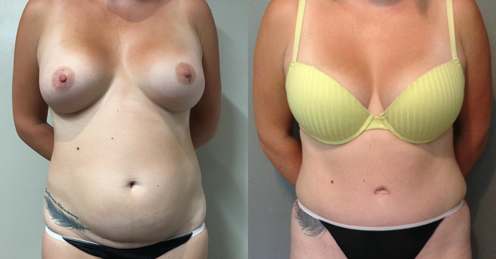 Before & After Tummy Tuck Case 118 Front View in Mississauga & Toronto, ON