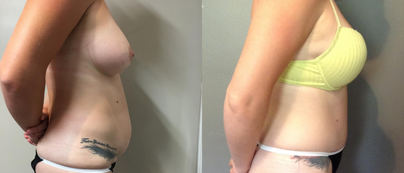 Before & After Tummy Tuck Case 118 Right Side View in Mississauga & Toronto, ON