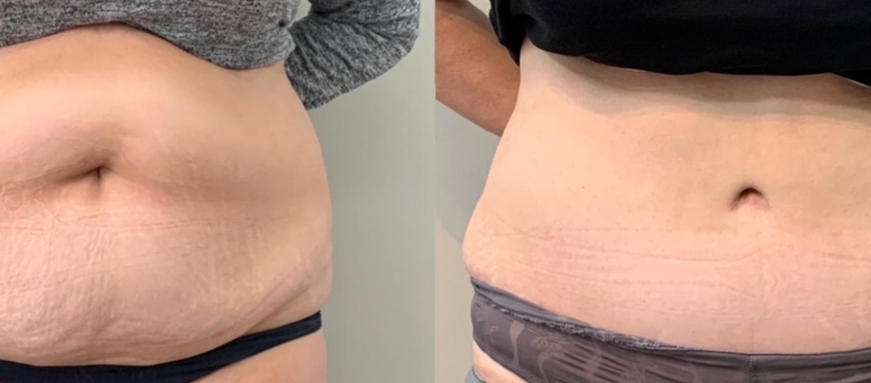 Before & After Tummy Tuck Case 119 Front View in Mississauga & Toronto, ON