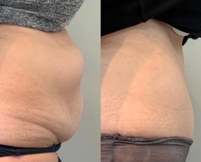 Before & After Tummy Tuck Case 119 Right Side View in Mississauga & Toronto, ON