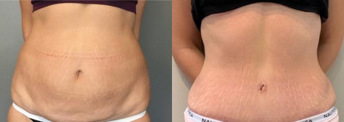 Before & After Tummy Tuck Case 121 Front View in Mississauga & Toronto, ON