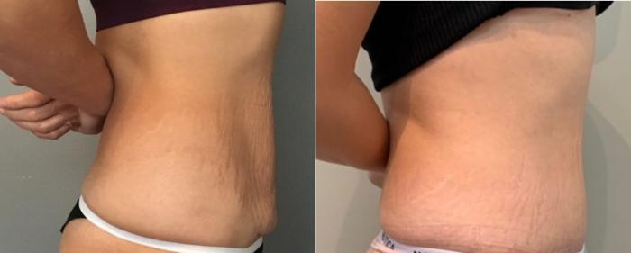 Before & After Tummy Tuck Case 121 Right Side View in Mississauga & Toronto, ON