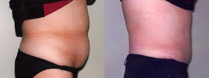 Before & After Tummy Tuck Case 13 View #2 View in Mississauga & Toronto, ON