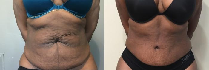 Before & After Tummy Tuck Case 134 Front View in Mississauga & Toronto, ON