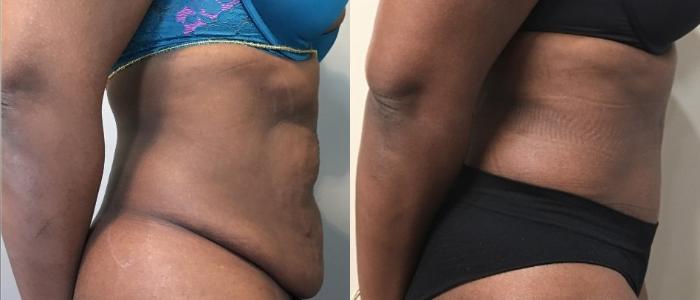 Before & After Tummy Tuck Case 134 Right Side View in Mississauga & Toronto, ON