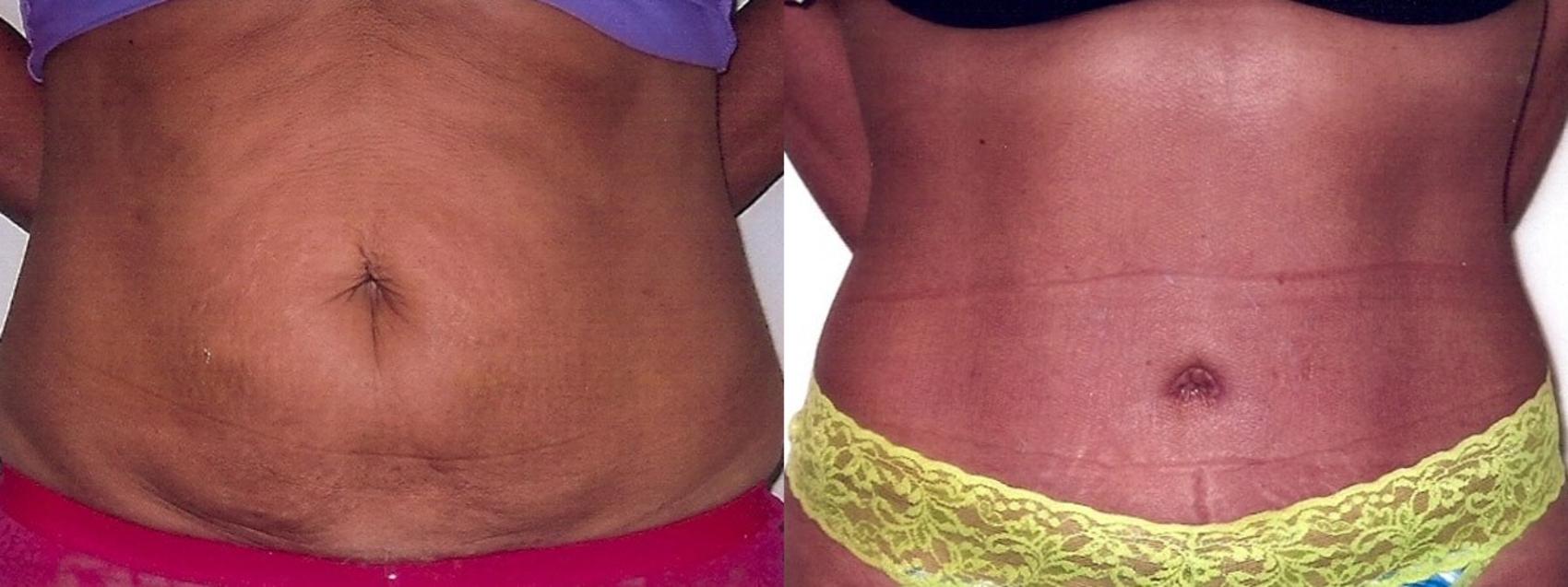 Before & After Tummy Tuck Case 17 View #1 View in Mississauga & Toronto, ON