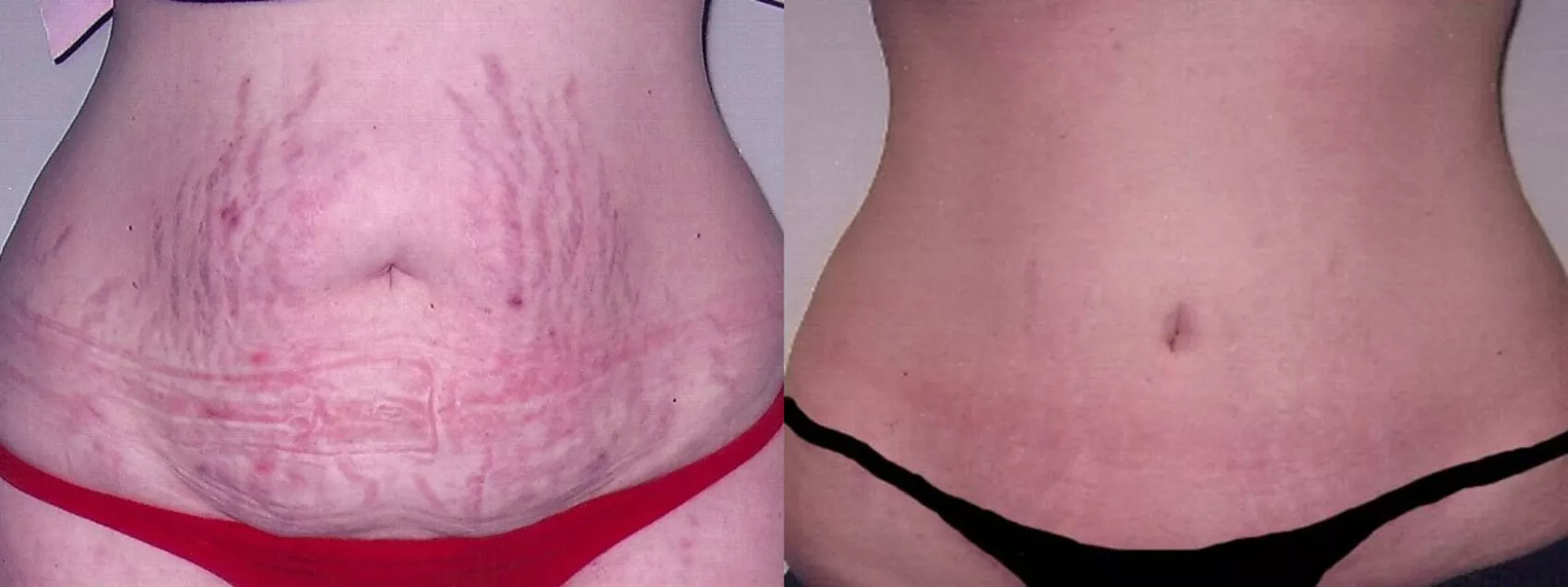 Tummy Tuck Before And After