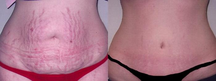 Before & After Tummy Tuck Case 19 View #1 View in Mississauga & Toronto, ON