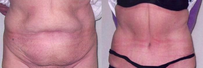 Before & After Tummy Tuck Case 26 View #1 View in Mississauga & Toronto, ON