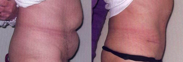 Before & After Tummy Tuck Case 26 View #2 View in Mississauga & Toronto, ON