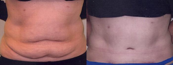 Before & After Tummy Tuck Case 3 View #1 View in Mississauga & Toronto, ON