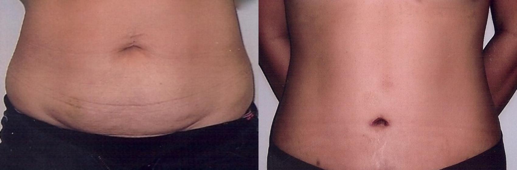 Before & After Tummy Tuck Case 52 View #1 View in Mississauga & Toronto, ON
