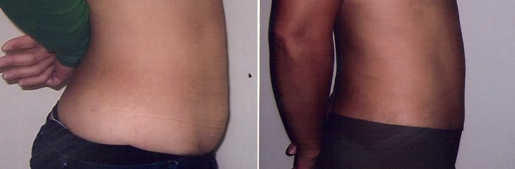 Before & After Tummy Tuck Case 52 View #2 View in Mississauga & Toronto, ON