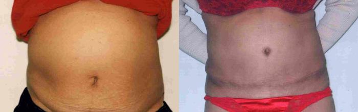 Before & After Tummy Tuck Case 65 View #1 View in Mississauga & Toronto, ON