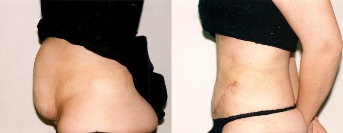 Before & After Tummy Tuck Case 71 View #1 View in Mississauga & Toronto, ON