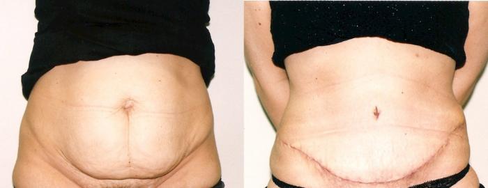 Before & After Tummy Tuck Case 71 View #2 View in Mississauga & Toronto, ON