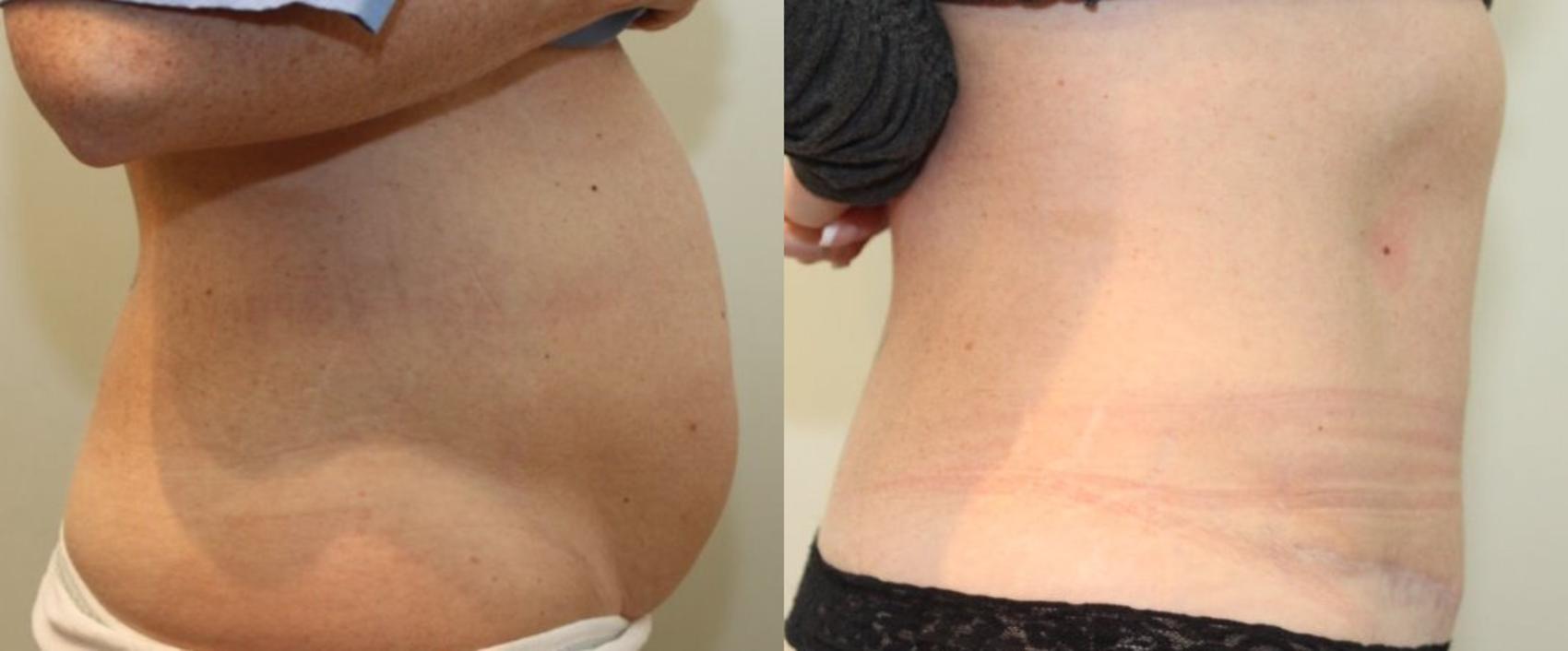 Before & After Tummy Tuck Case 89 View #2 View in Mississauga & Toronto, ON
